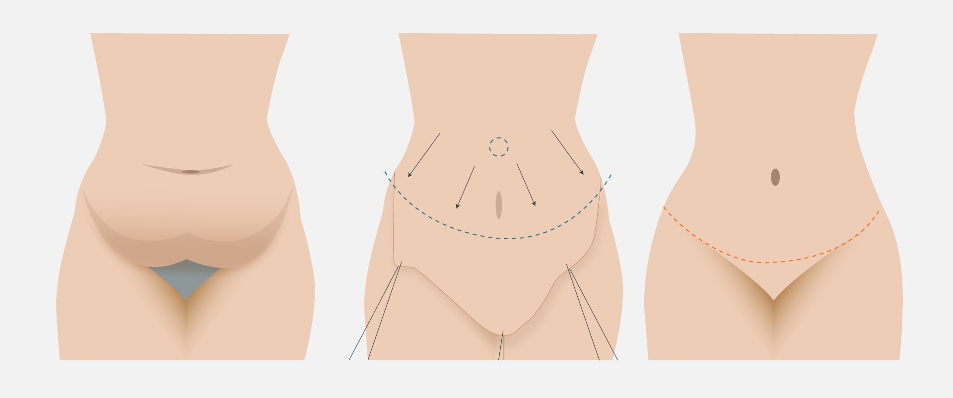 Lipoabdomino_dibujos-02-03-min