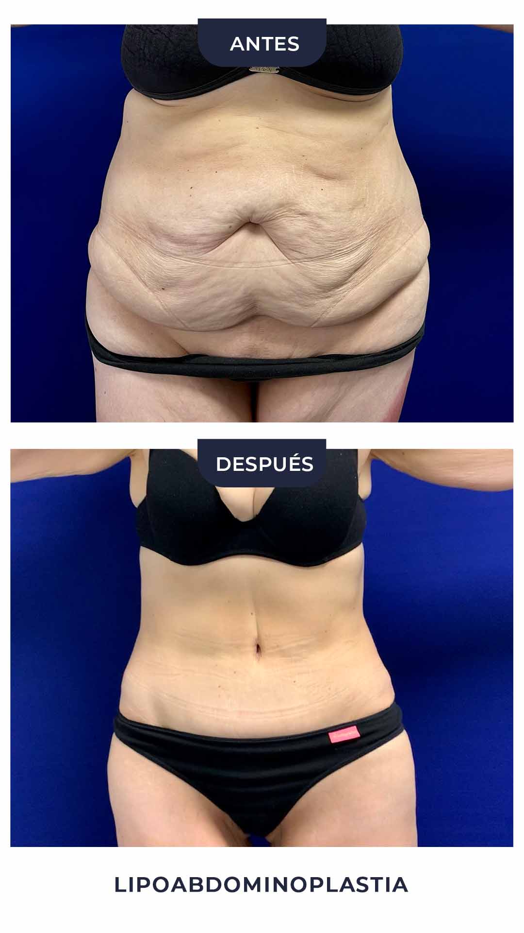 Lipoabdominoplastia