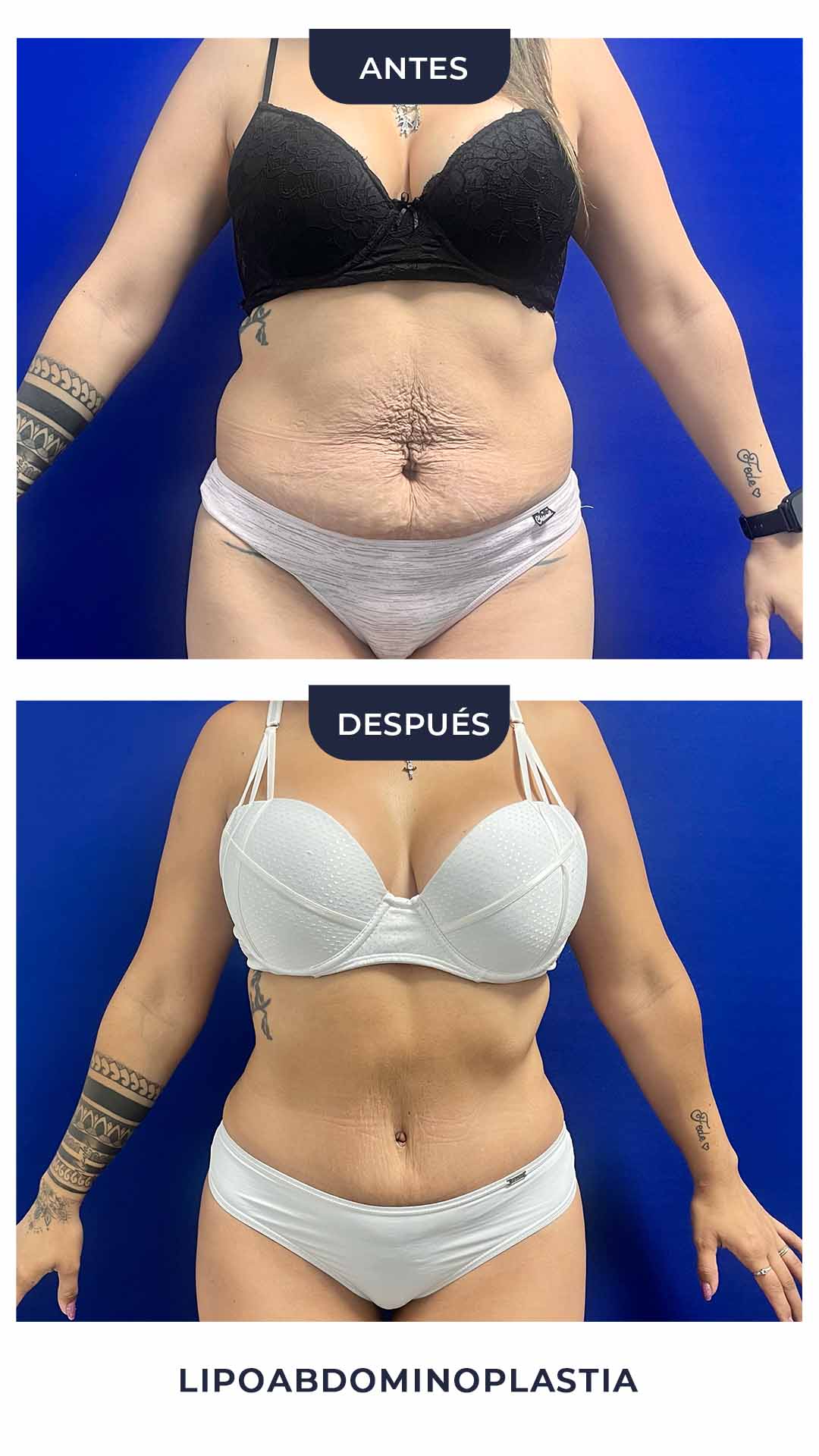 Lipoabdominoplastia