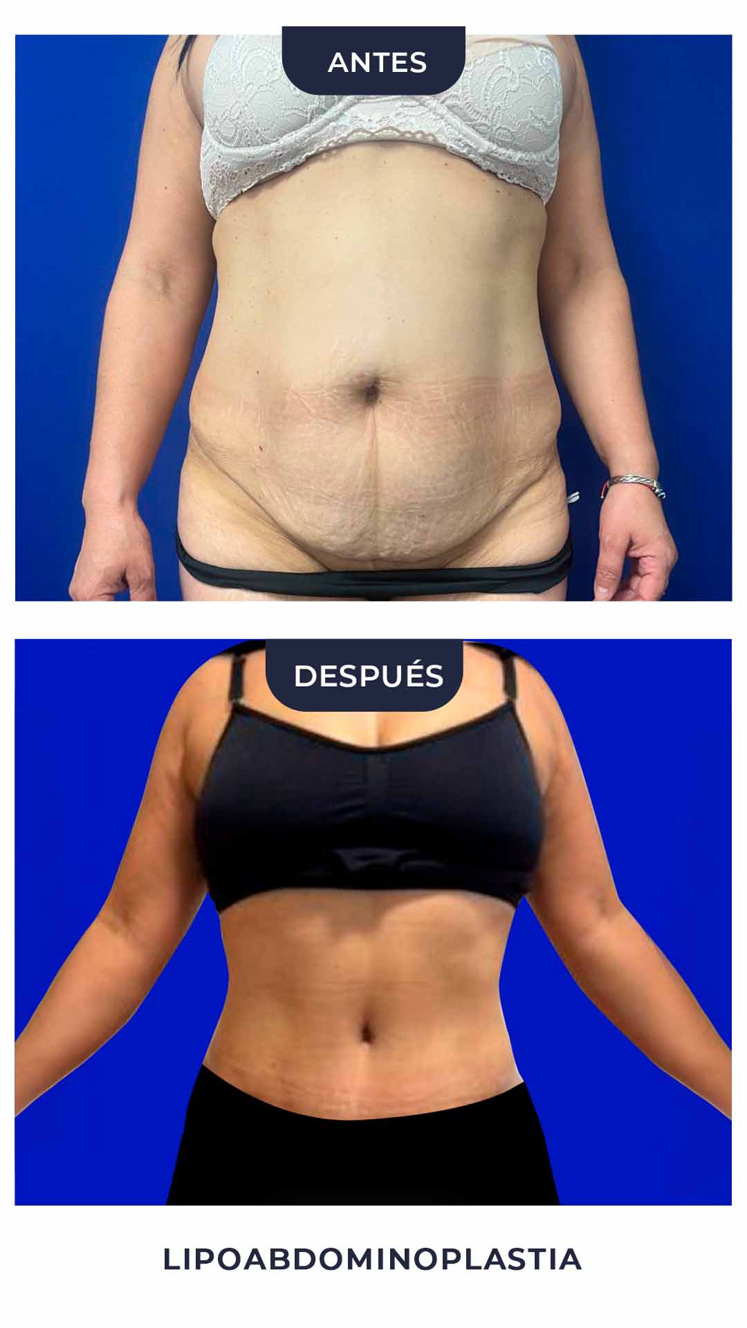 Lipoabdominoplastia 2026 1