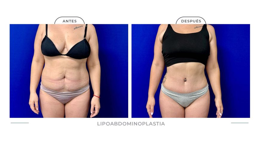 Alamo_Lipoabdomi-1