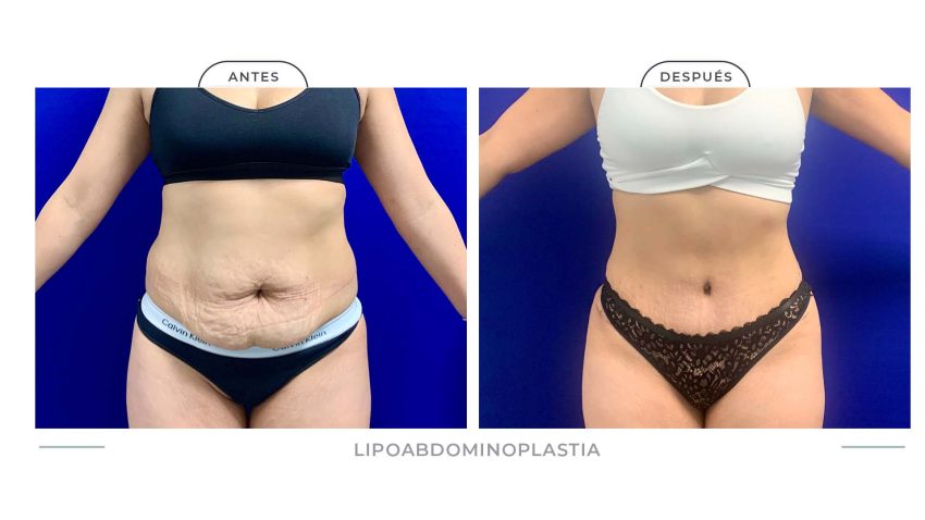 Alamo_Lipoabdomi-10