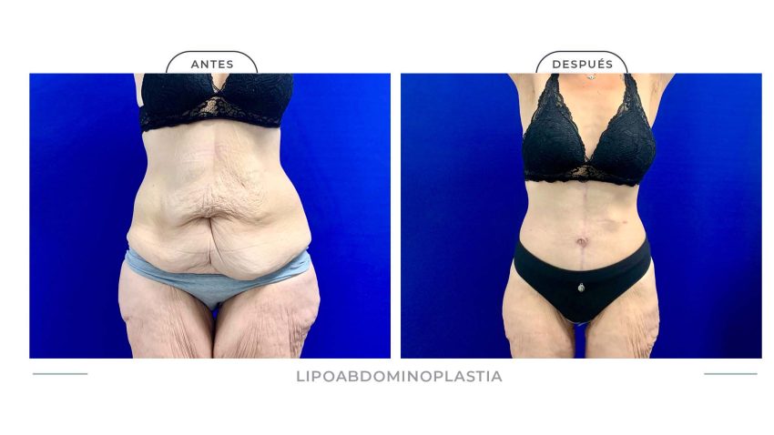 Alamo_Lipoabdomi-11