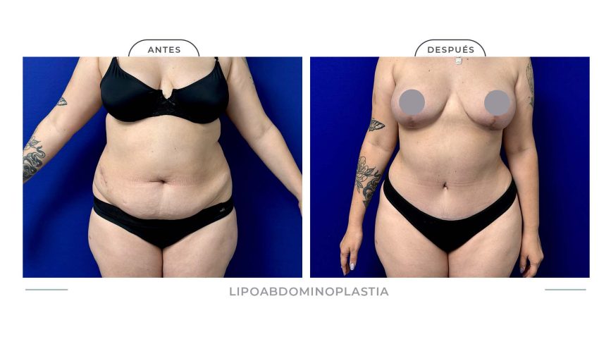 Alamo_Lipoabdomi-12