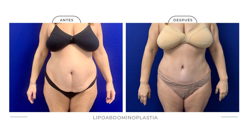 Alamo_Lipoabdomi-13