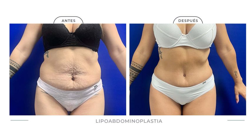 Alamo_Lipoabdomi-3