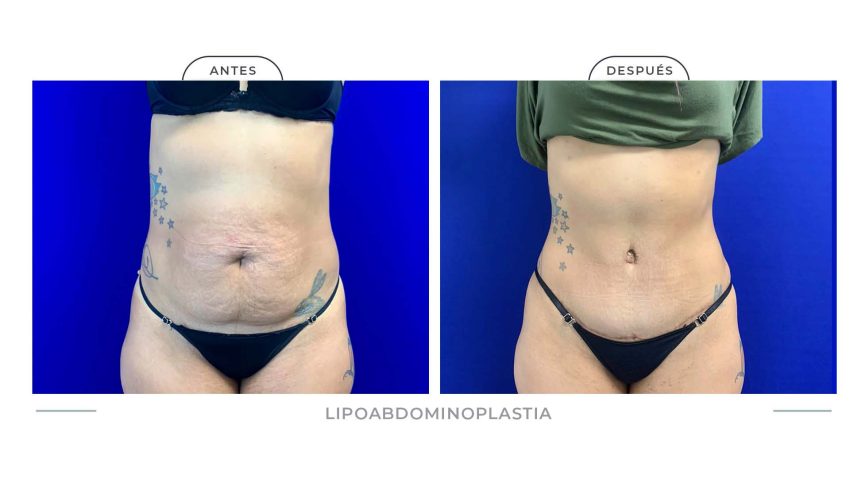 Alamo_Lipoabdomi-6