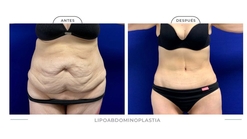 Alamo_Lipoabdomi-7