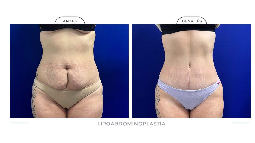 Alamo_Lipoabdomi-8