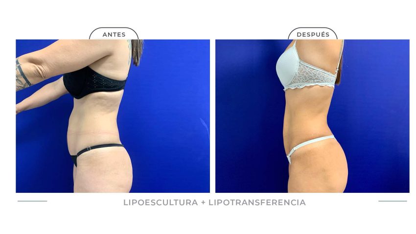 Alamo_Lipoescultura-9