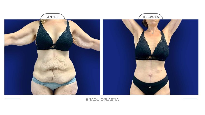 Alamo_braquioplastia_nvo