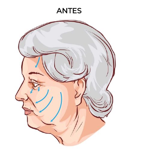 LIFTING-PROCEDIMIENTO-1