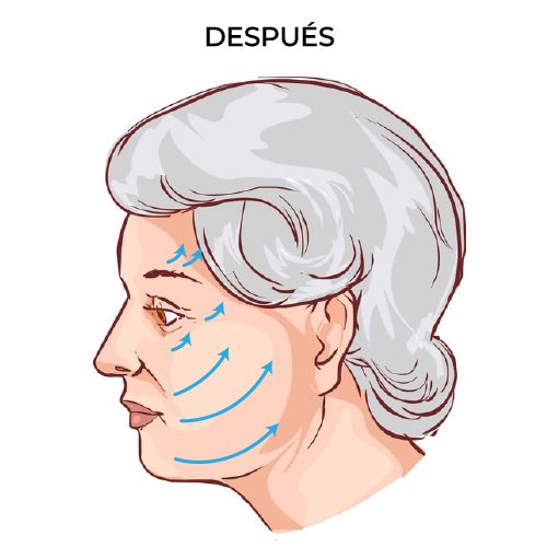 LIFTING-PROCEDIMIENTO-2