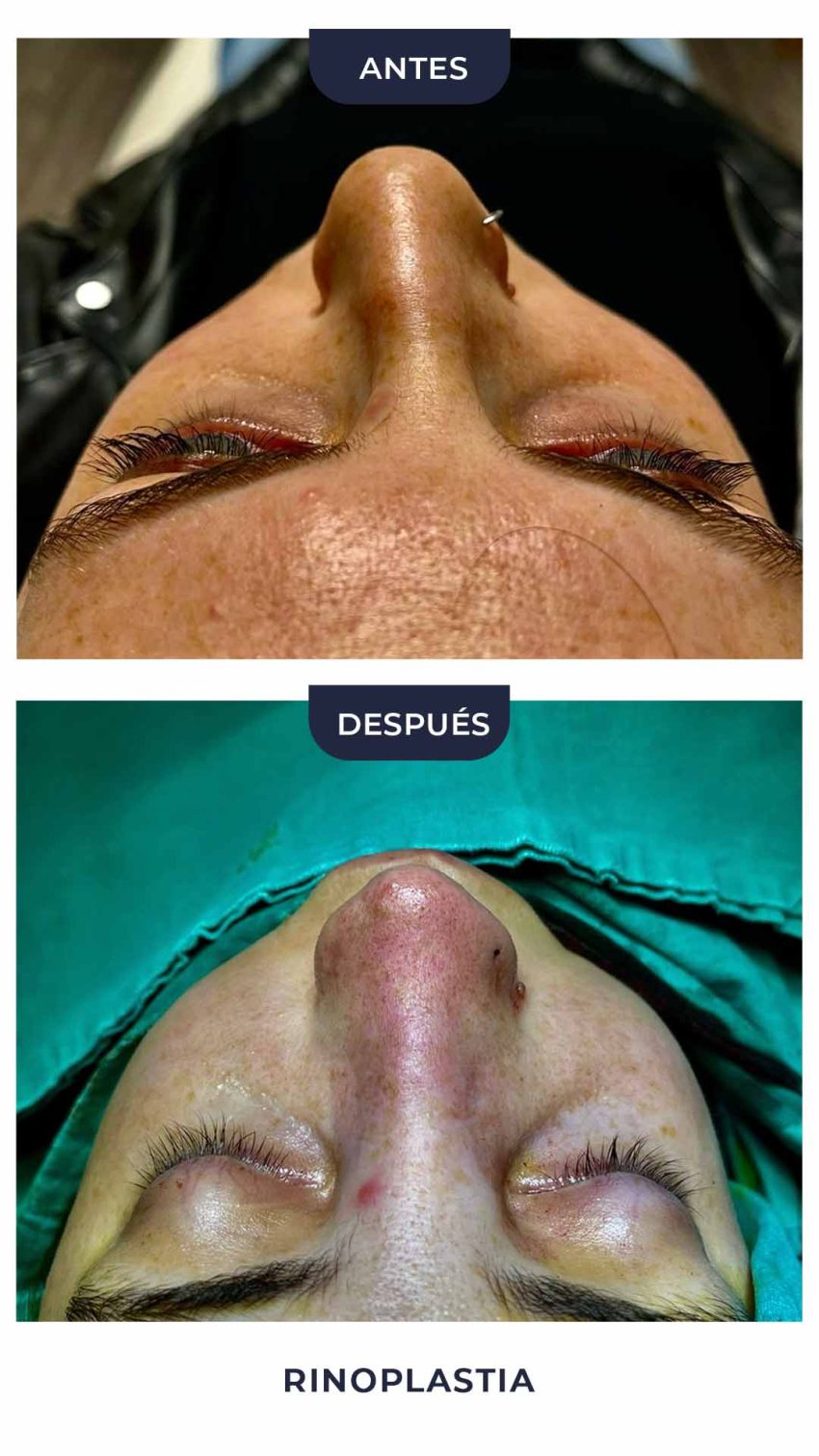 Rinoplastia-1