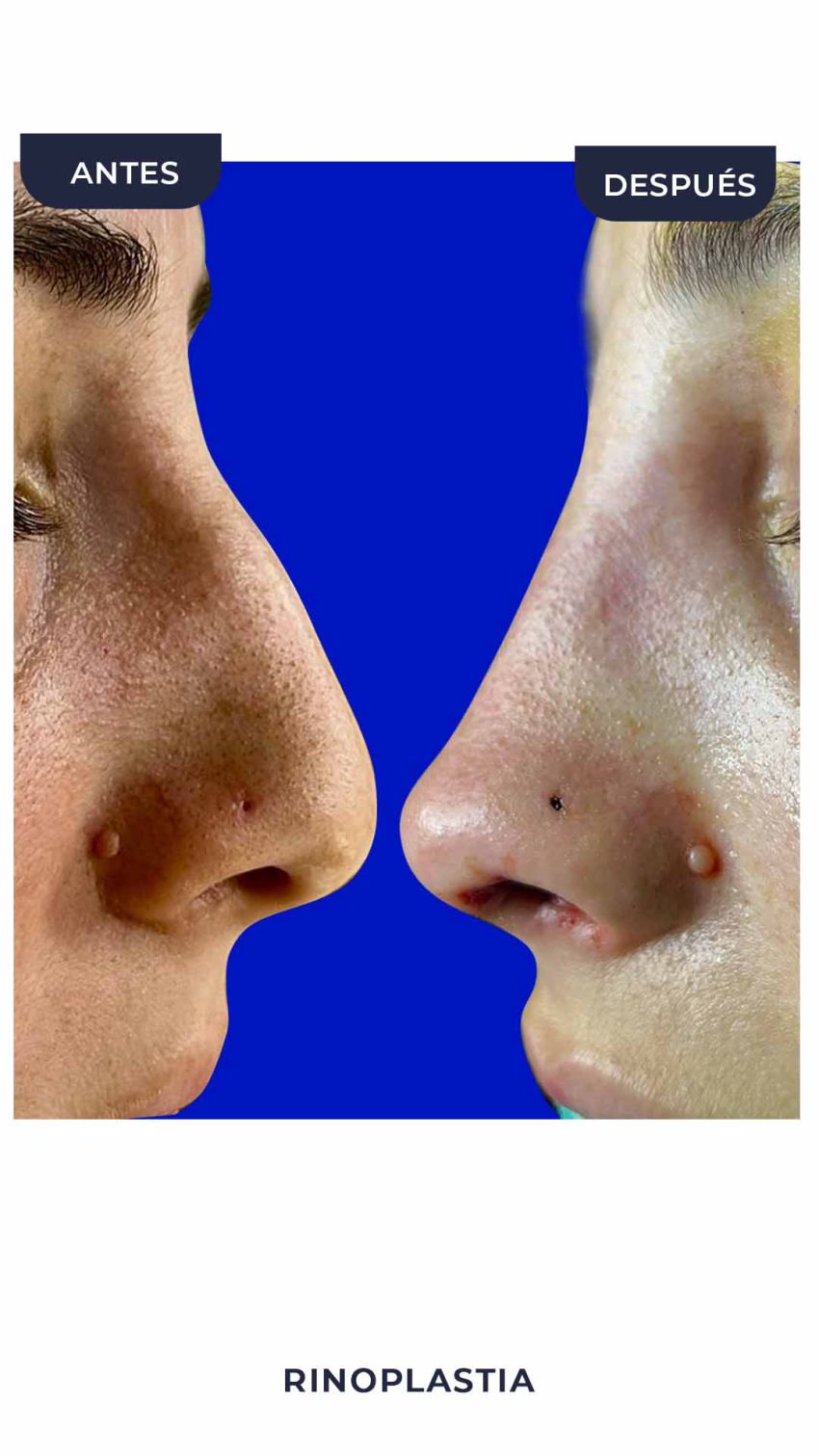 Rinoplastia-2