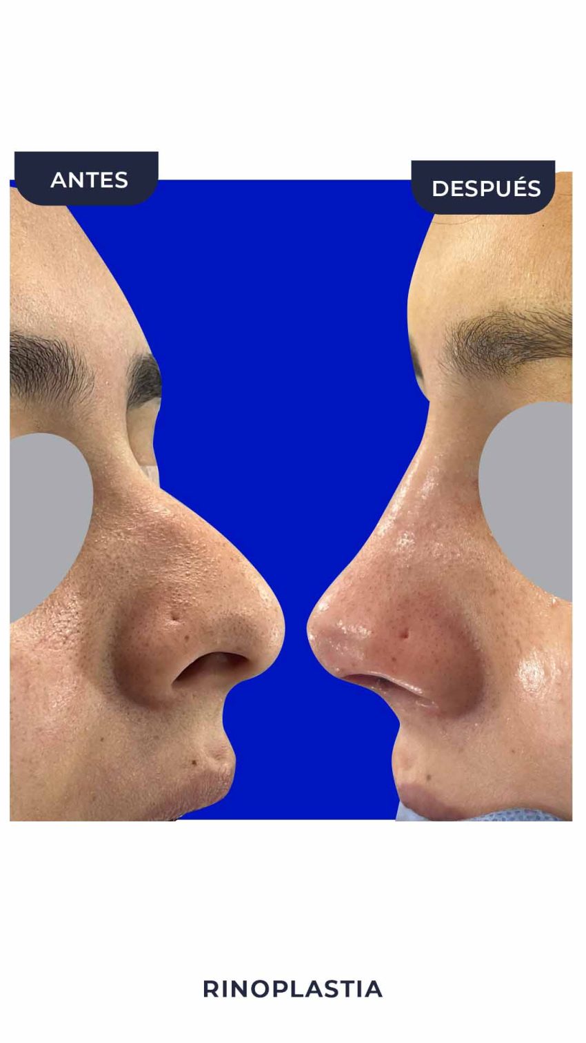 Rinoplastia-3