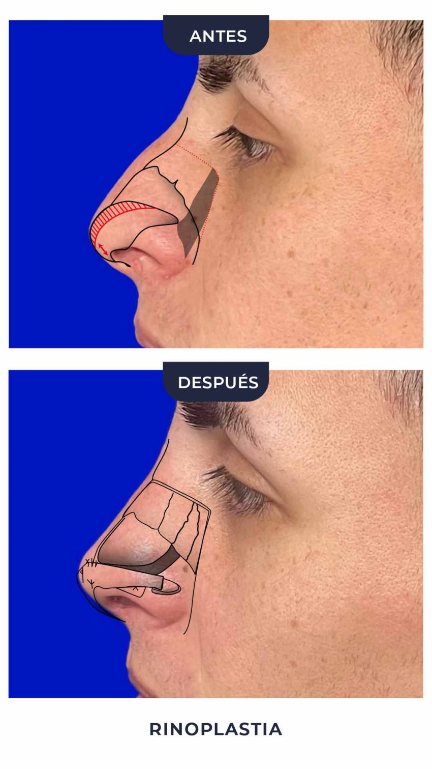 Rinoplastia-4