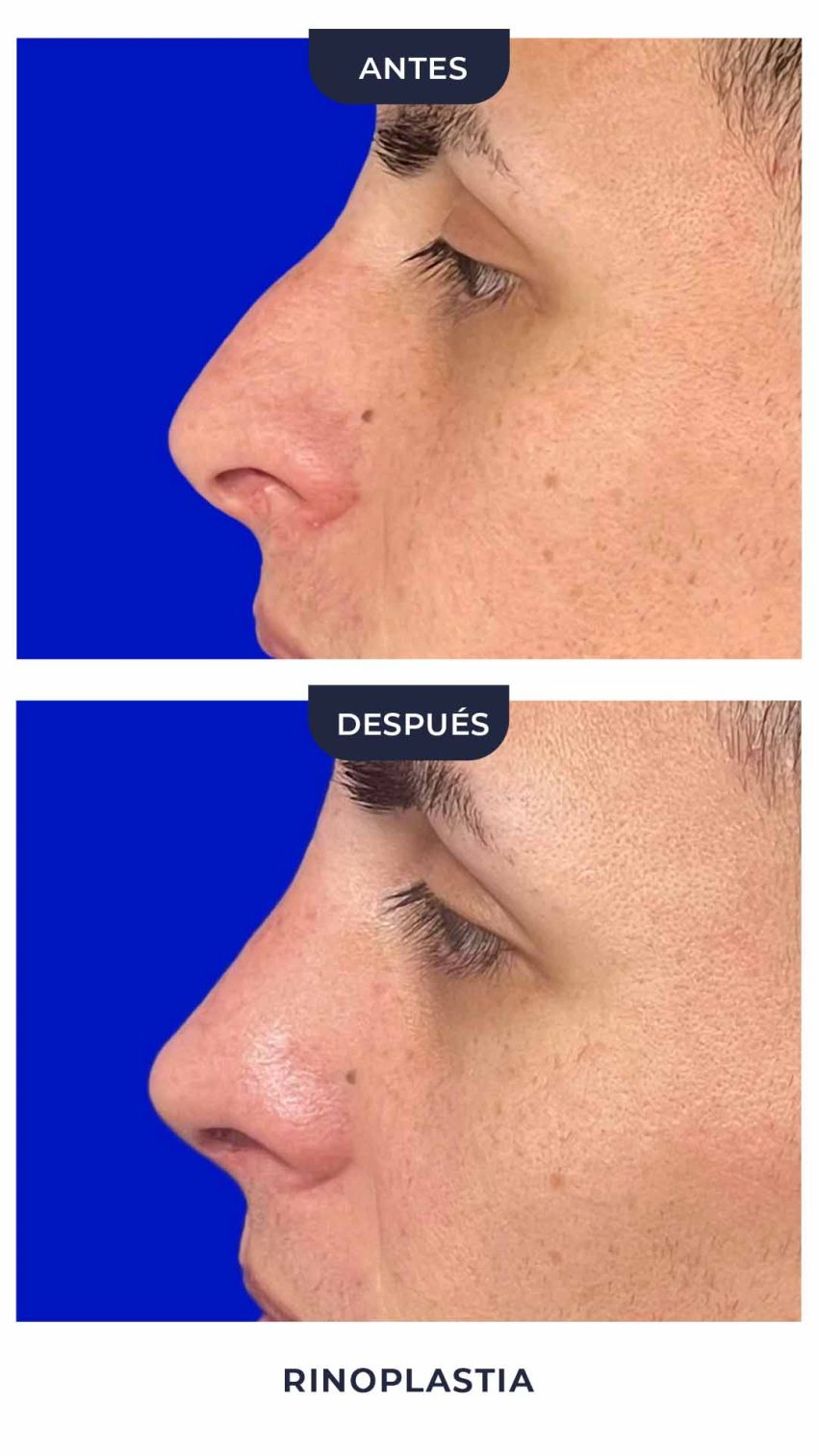 Rinoplastia-5
