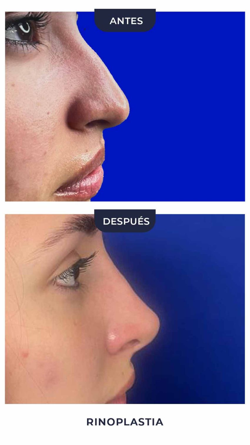 Rinoplastia-6