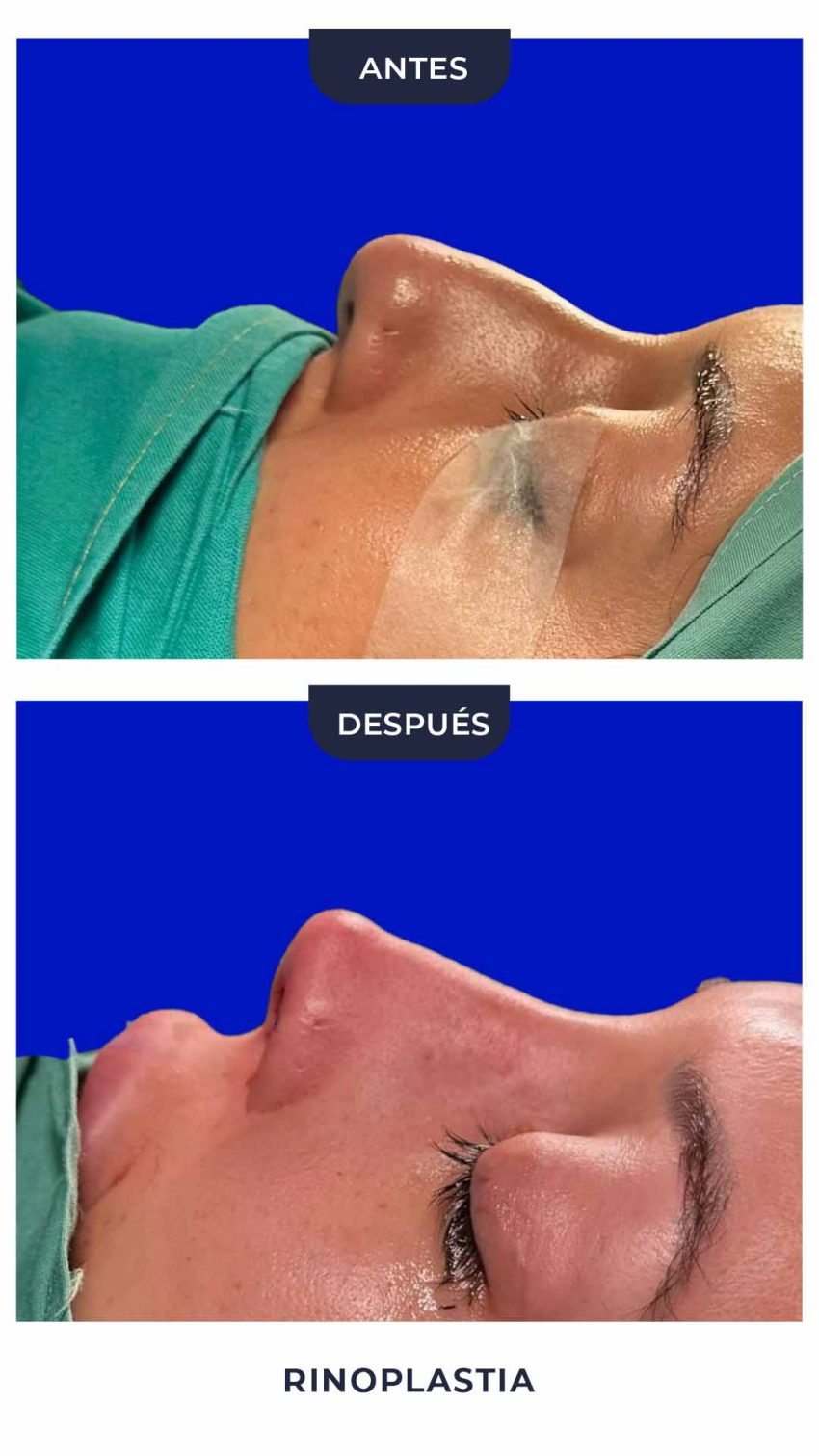 Rinoplastia-7