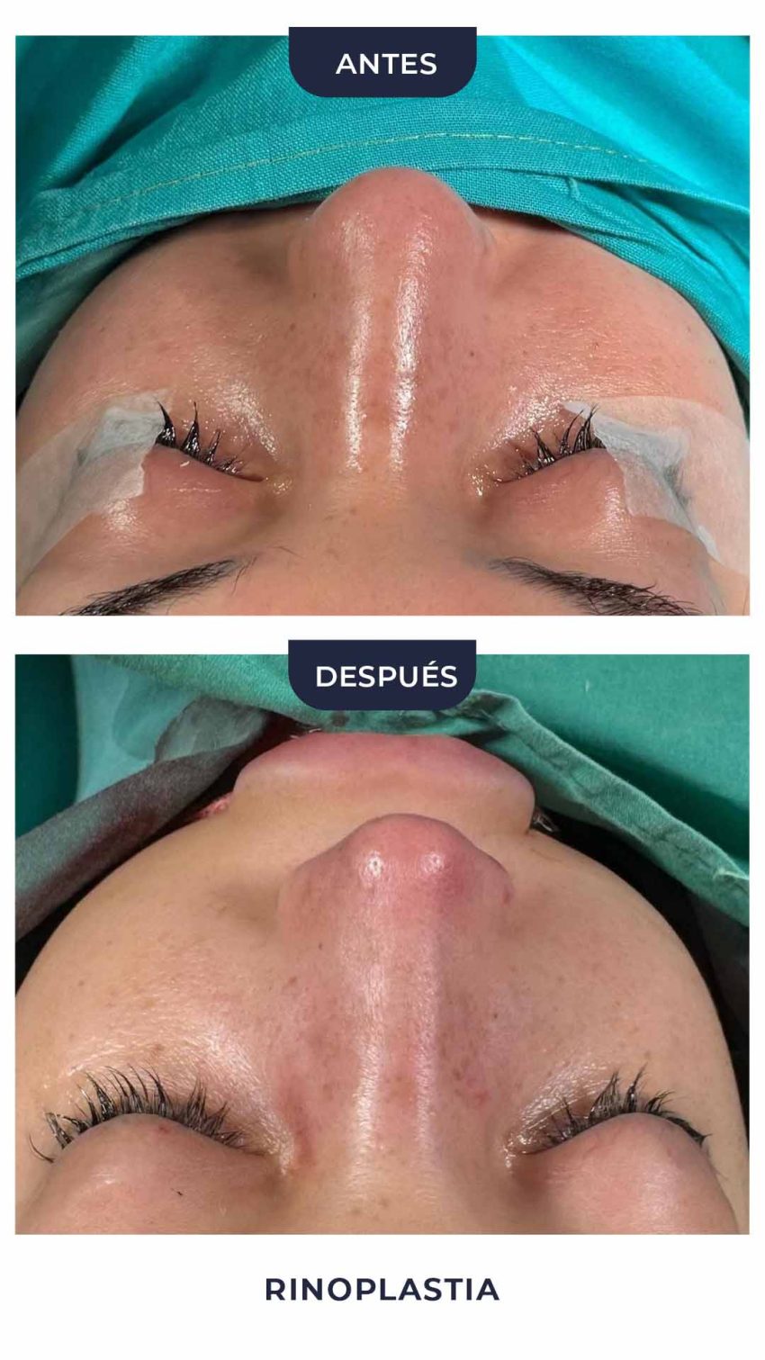 Rinoplastia-8