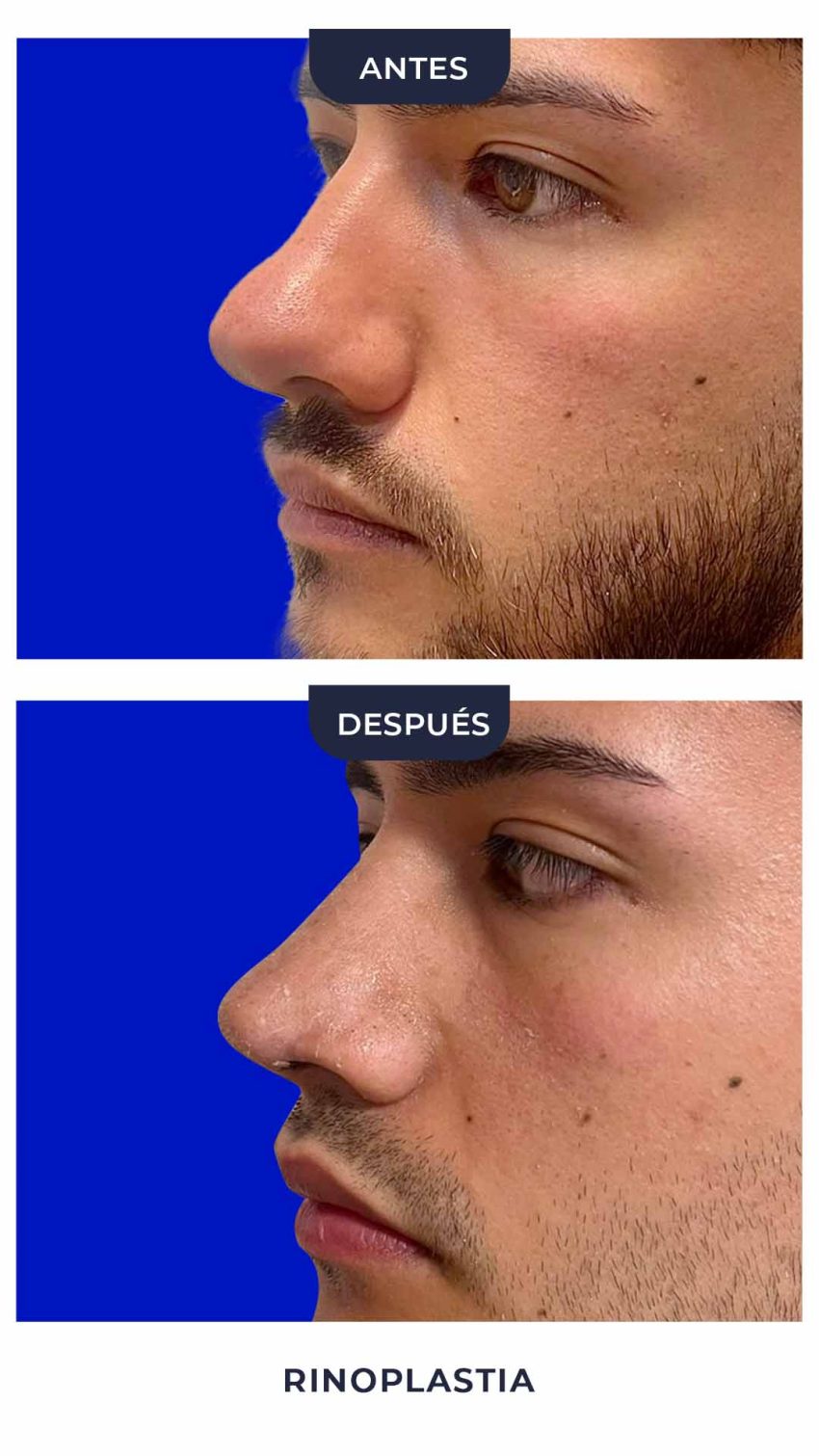 Rinoplastia-8
