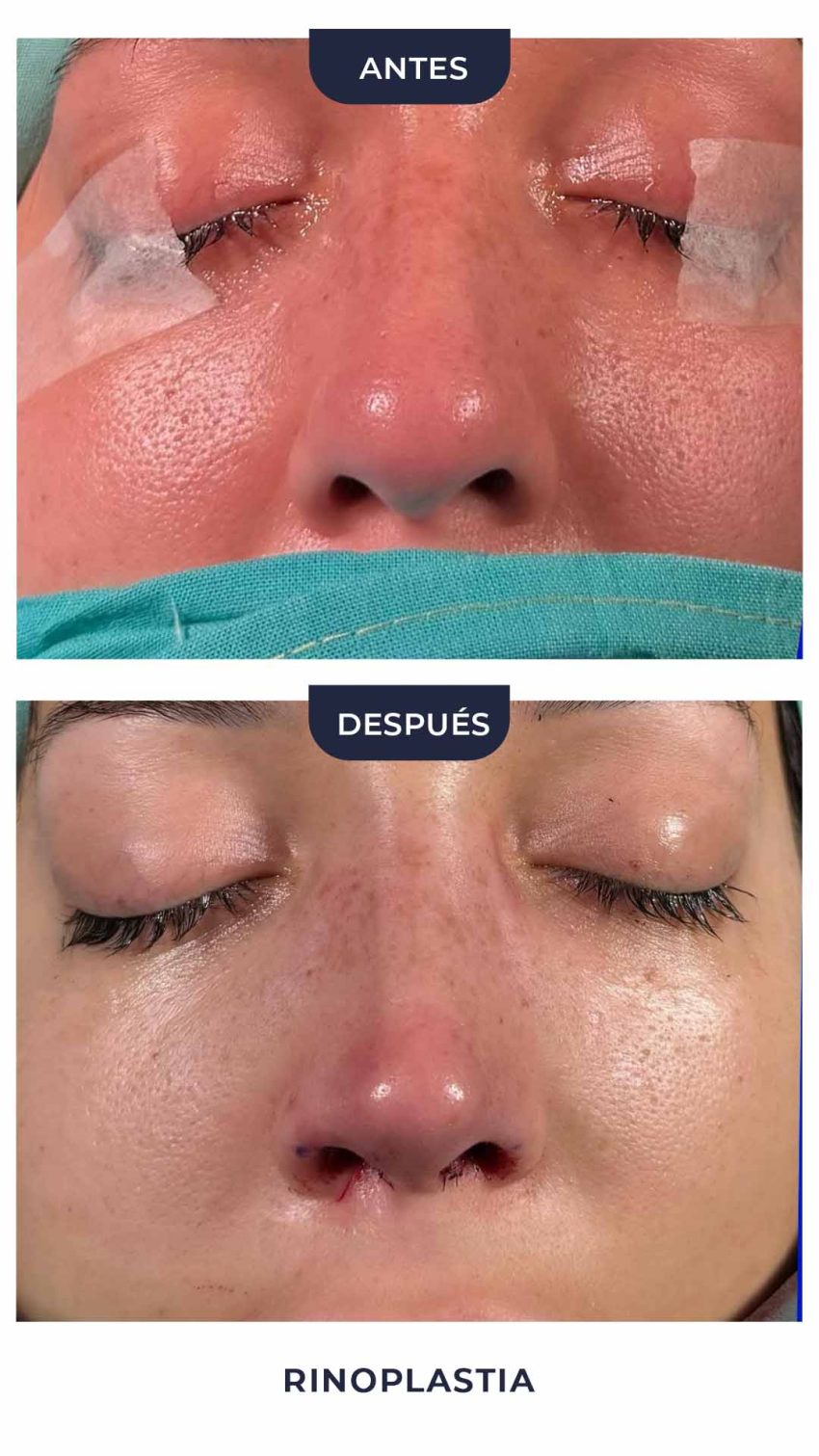 Rinoplastia-9